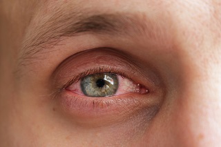 INFLAMACION EN LA CONJUNTIVA
